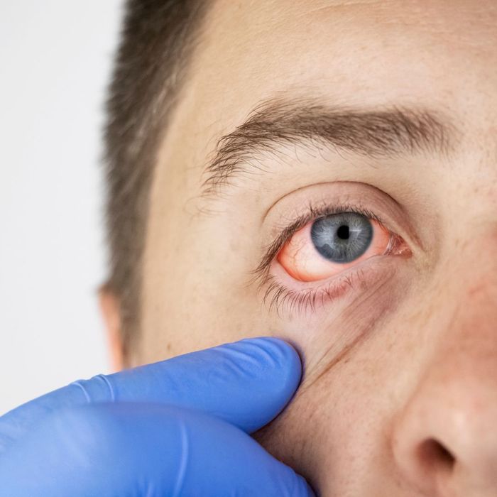 Understanding the Connection Between Allergies and Eye Irritation-image2.jpg