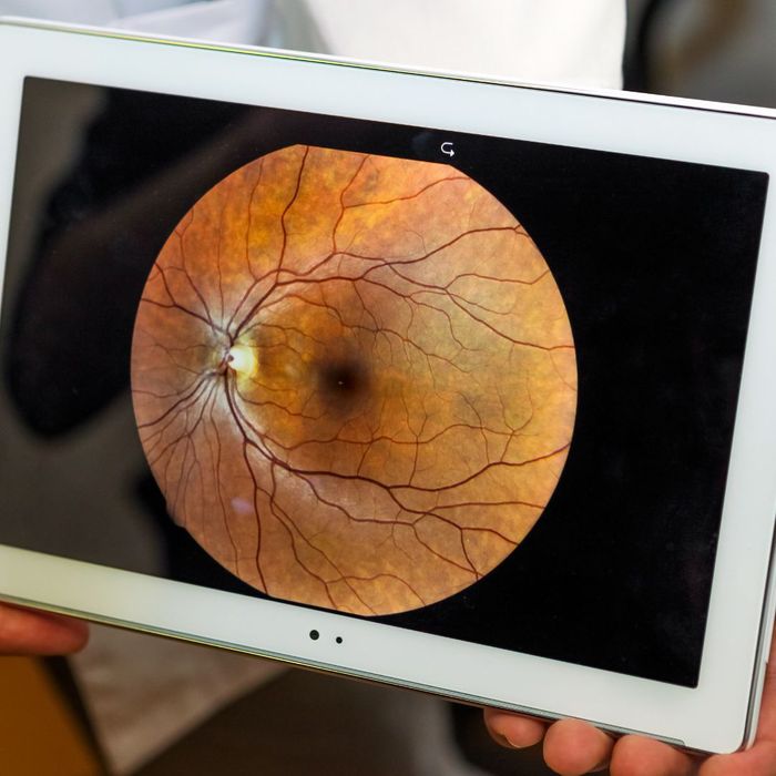 Tablet showing an image of an eye with macular degeneration. 