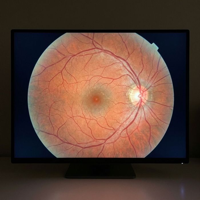 A glowing computer screen displaying a highly detailed and clear digital scan of a healthy human retina.