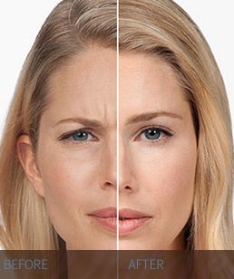 BOTOX BOTOX-before-and-after-Hidden-Door-Medspa-Southlake-1.jpg