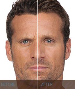 BOTOX BOTOX-before-and-after-3-Hidden-Door-Medspa-Southlake.jpg