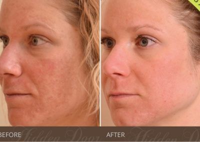Halo-Hybrid-Fractional-2-before-after-hidden-door-400x284.jpg
