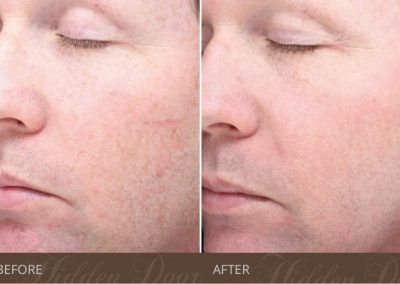Halo-Hybrid-Fractional-4-before-after-hidden-door-400x284.jpg