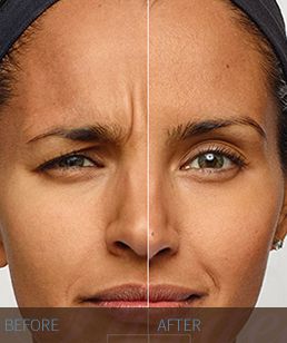 DYSPORT Dysport-before-and-after-Hidden-Door-Medspa-Southlake.jpg
