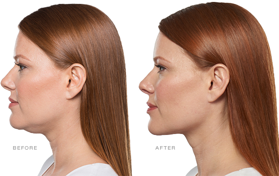 Before and After Kybella Treatment AboutKybella.png