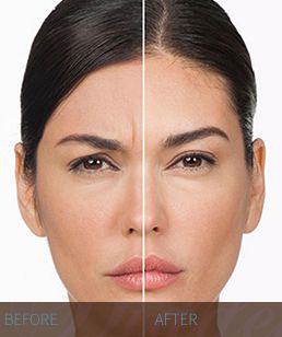 BOTOX BOTOX-before-and-after-2-Hidden-Door-Medspa-Southlake.jpg
