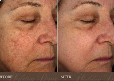 Halo-Hybrid-Fractional-1-before-after-hidden-door-400x284.jpg