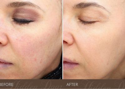 Halo-Hybrid-Fractional-3-before-after-hidden-door-400x284.jpg