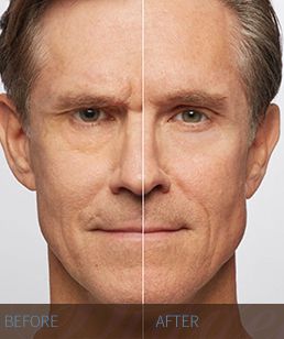 DYSPORT Dysport-before-and-after-2-Hidden-Door-Medspa-Southlake.jpg