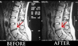 spinal-decompression-before-and-after1-300x175.jpg