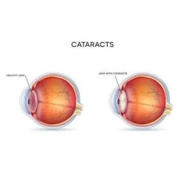 cataract 1.jpg
