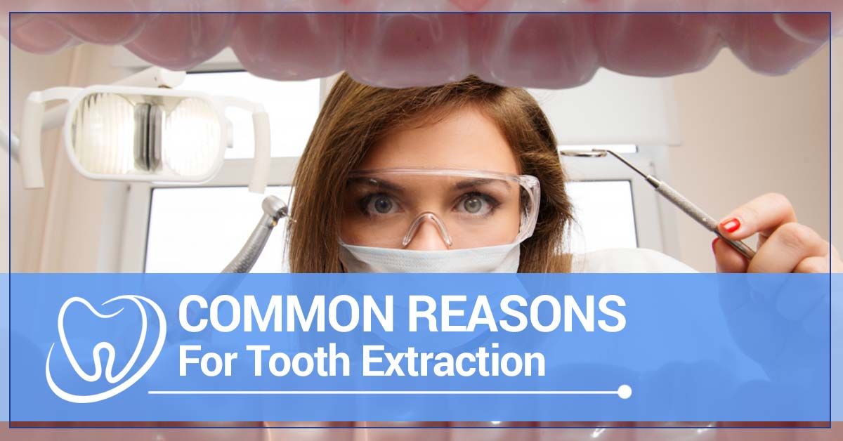 Common-Reasons-For-Tooth-Extraction-5b3b7ef4b596a.jpg