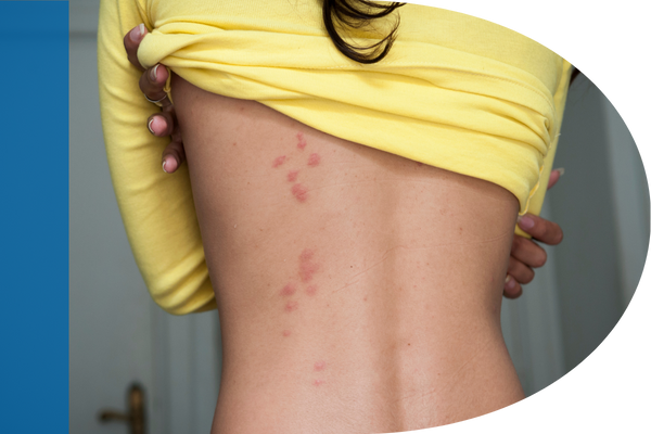 woman with bedbug bites on her back