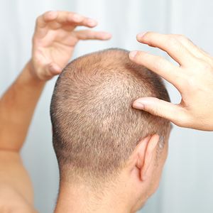 man with thinning hair