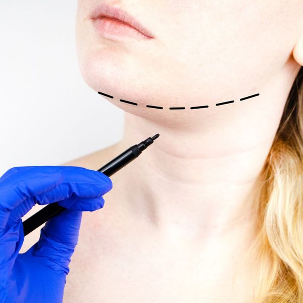 person getting outline on chin for procedure