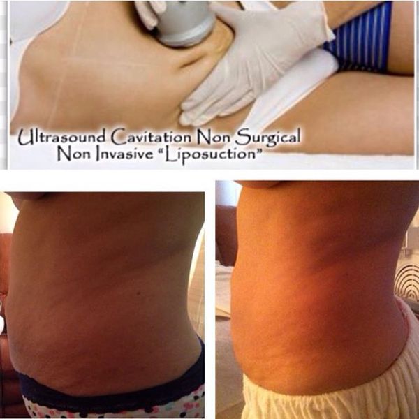 The Ultrasound Cavitation Treatment Process