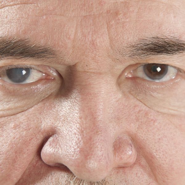Glaucoma 3.jpg