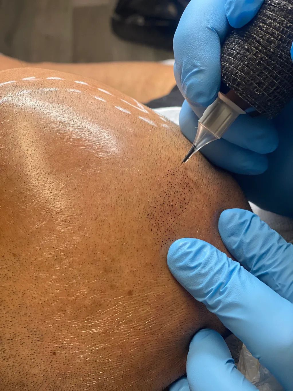 bald man receiving Skin Micropigmentation ink