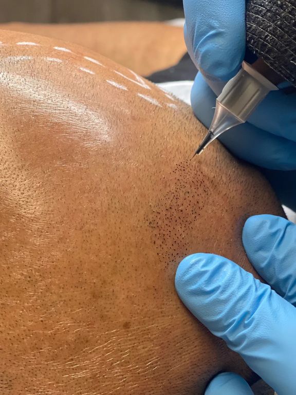 bald man receiving Skin Micropigmentation ink