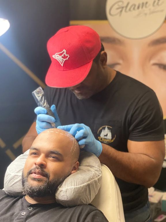 bald man receiving Skin Micropigmentation ink