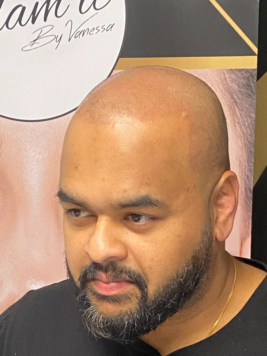 bald man receiving Skin Micropigmentation ink