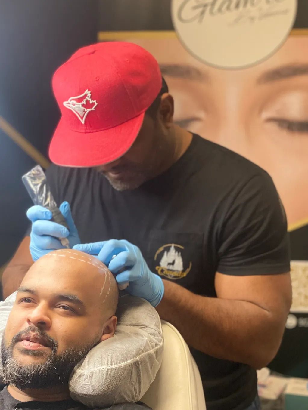 bald man receiving Skin Micropigmentation ink