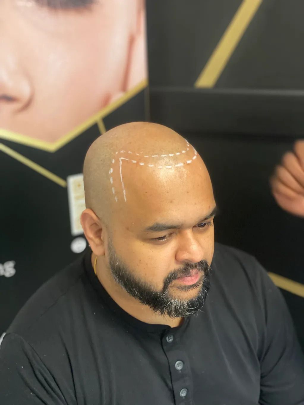 bald man receiving Skin Micropigmentation ink