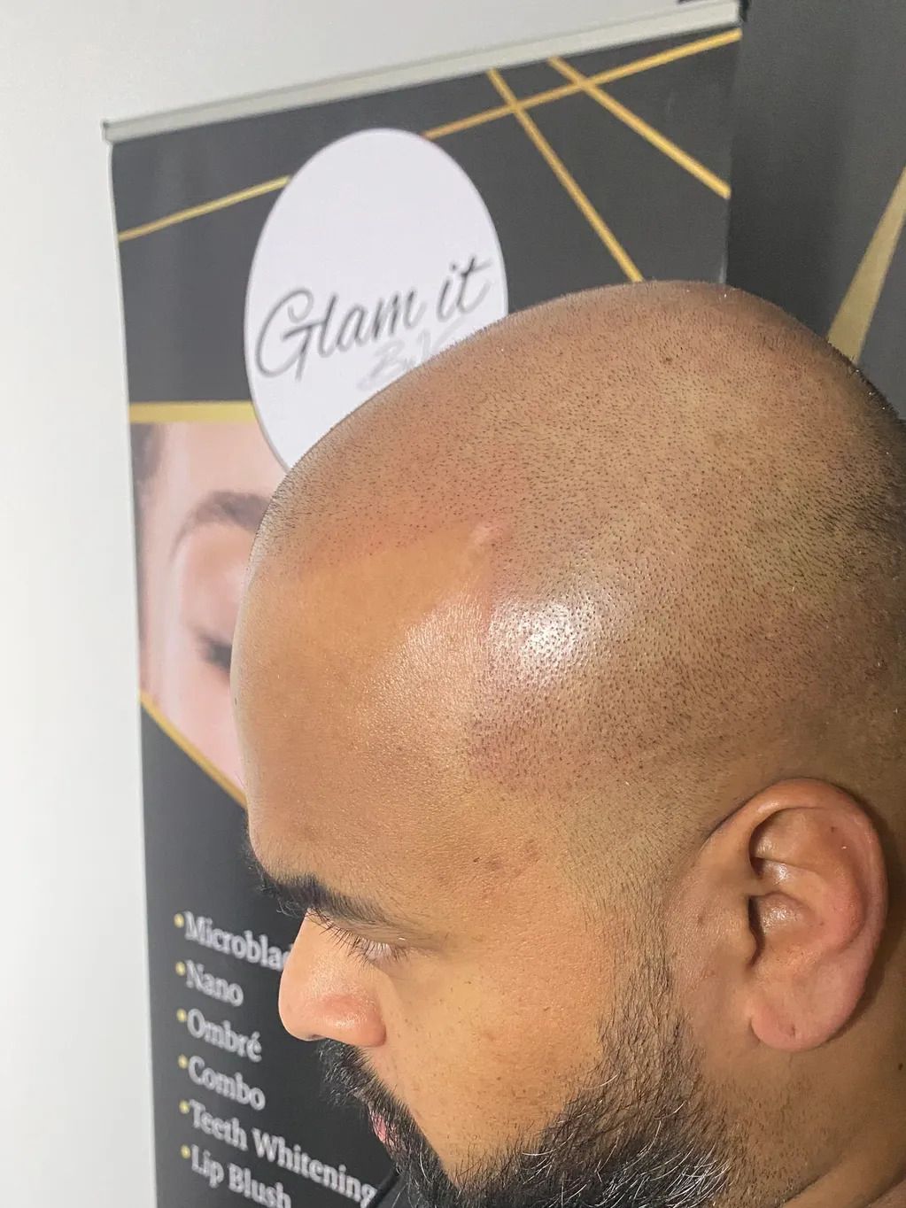 bald man receiving Skin Micropigmentation ink