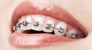 A closeup of braces