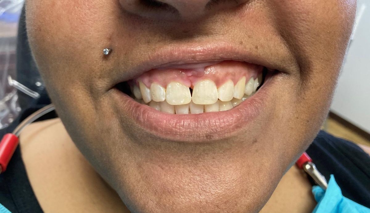 invisalign