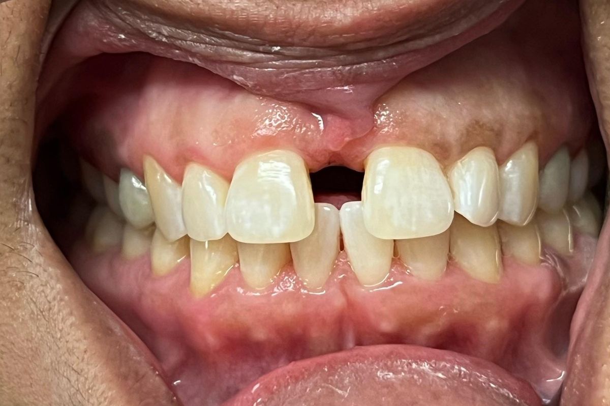 misaligned teeth