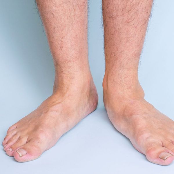 man standing with flat feet