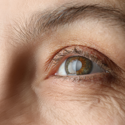 image - services - cataracts 1.png