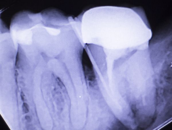 Dental-Crowns-5b69b0dbd78a4.jpg