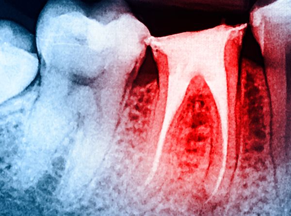 Root-Canals-5b69ab07ee1d1.jpg