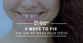 4-Ways-To-Fix-The-Gap-Between-Your-Teeth-5c2548f36f4dd-280x146.jpg