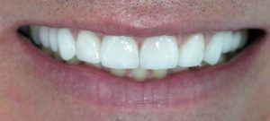 As the case was completed we reassess whether our goals were met. (1) All spaces are closed between his teeth. (2) The crowns are continuous with the gum tissues. (3) The teeth have a natural shape and do not appear too large. (4) The teeth are the color the patient desired. The most important goal of treatment achieved was that the patient was happy with the final results.
 Figure 7