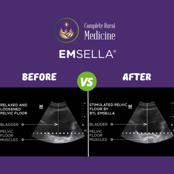 Emsella before and after