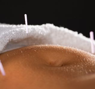 Image of acupuncture 