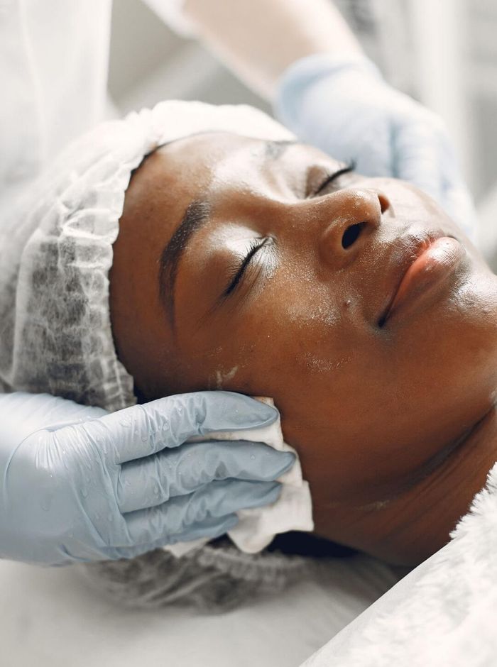 3chemicalpeel.jpg