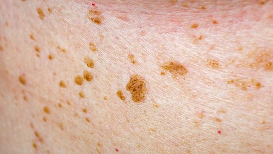 hyperpigmentation.jpg