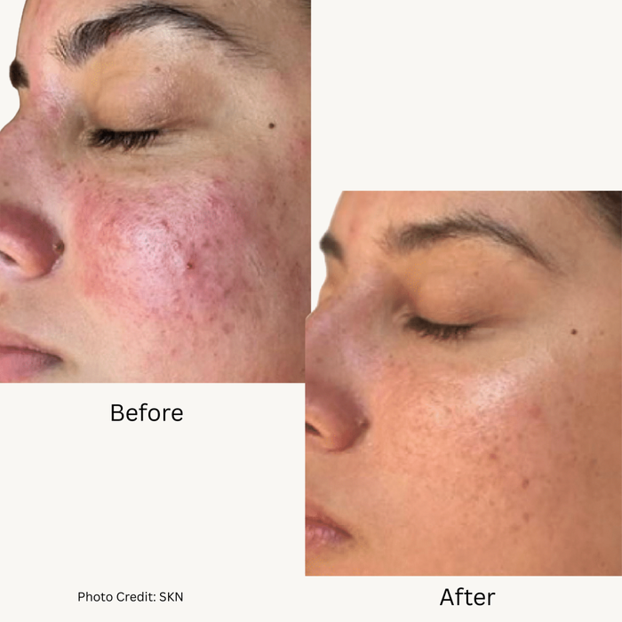 ADVATx LAser Blog 4.png