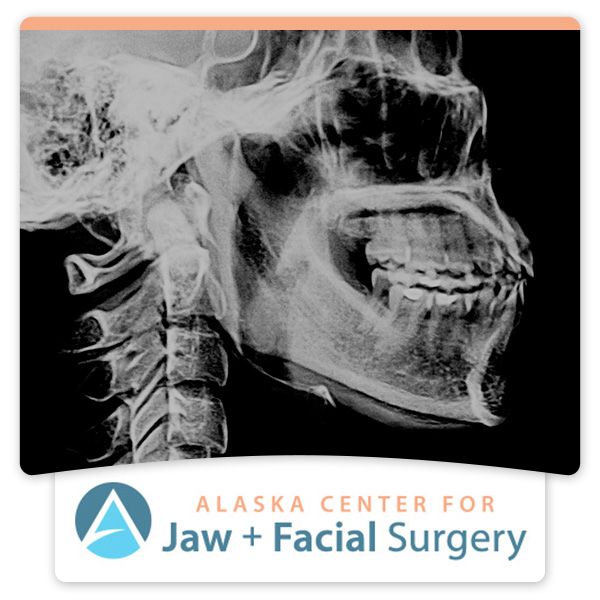 jaw x-ray, alaska center for jaw + facial surgery