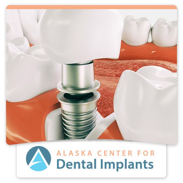 render of implant tooth, Alaska center for dental implants logo