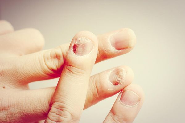 image of damaged nails