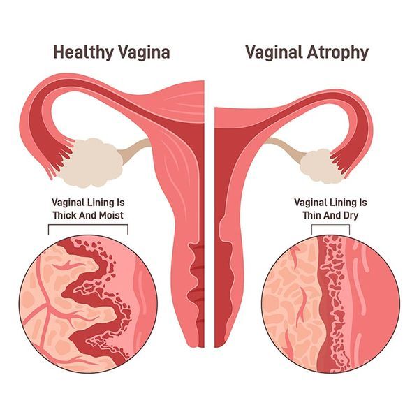 Vaginal-Atrophy.jpg