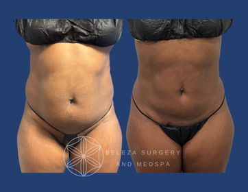 Patient 20 Lipo 360 and Bra Rolls Anterior (1).jpg