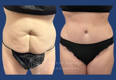 Patient 17 Abdominoplasty (2).jpg