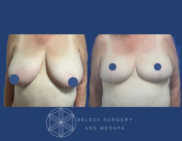 Patient 3 Breast Reduction Anterior (1).jpg
