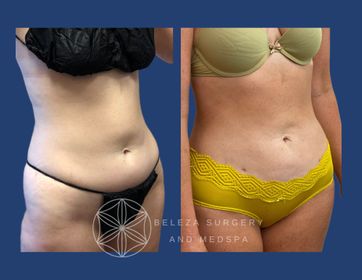 Patient 26 Lipo 3AA Right Oblique (1).jpg